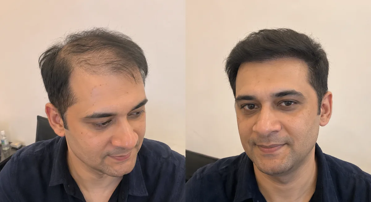 Customised hair patch with natural undetectable finish, HairBrisé Sydney